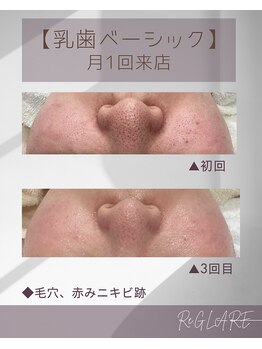 リグレア 浦安(Re.GLARE)/毛穴