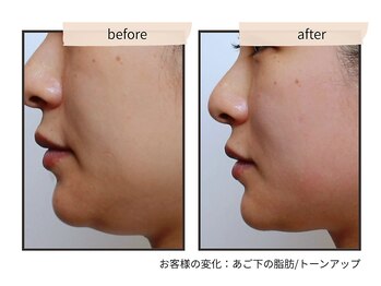 コンビンス(convince)の写真/二重あご・フェイスラインが気になる方へ|顔だけで終わらない小顔ケア