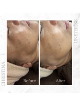 シャルムパリス(charme paris)/肌の土台作り♪１回の施術変化