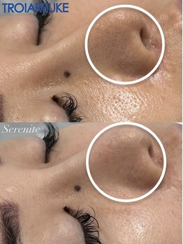 セレニテ(Serenite)/症例写真