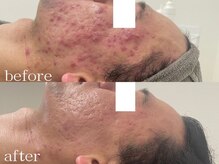 リスト(Rist TOTAL BEAUTY)/2025ニキビ部門全国1位:受賞写真