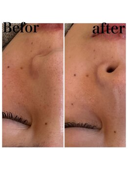 ペルボヌール 深井店/剥けないハーブピーリング