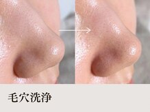 レイミー(reimee)/【毛穴洗浄】Before/After