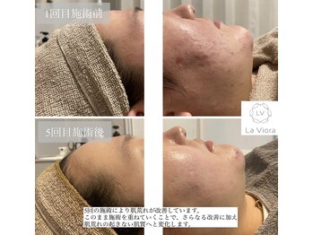 ラヴィオーラ 栄(LV)/ダイヤモンドハーブピーリング