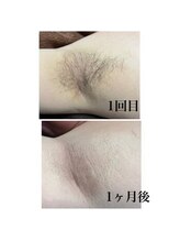 エース 赤坂/わき脱毛経過写真