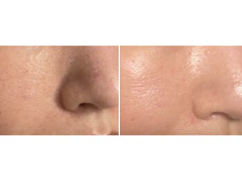 パーフェクトボディ(PERFECT BODY)/ハイドラフェイシャルで毛穴ナシ