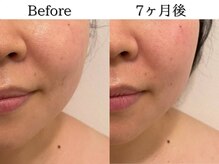 ポポラス(POPOLUS)の雰囲気（まぶたやほうれい線など、お顔のたるみケアには小顔コース）