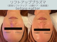 シエスタ(siesta)/リフトアッププラズマ・小顔ケア