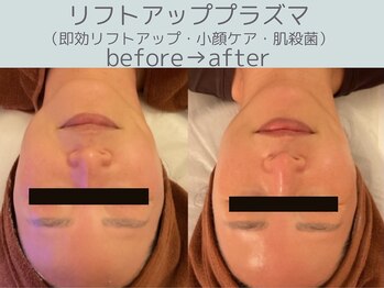 シエスタ(siesta)/リフトアッププラズマ・小顔ケア