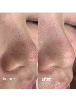 メンテ(MENTE)/毛穴撃退！