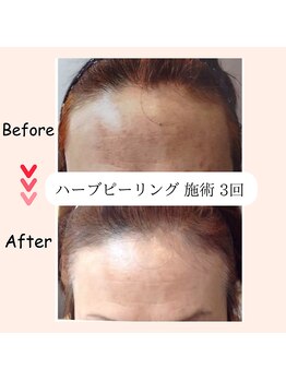 縁 整体院 和歌山院(en)/ハーブピーリング