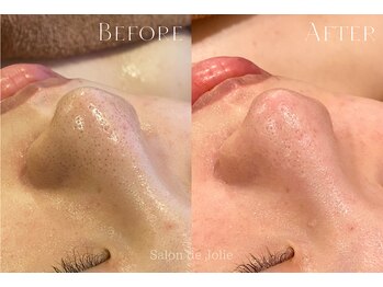 サロンドジョリー(Salon de Jolie)/【ハイドロ毛穴洗浄】
