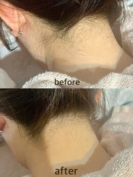 マナ(mana)/うなじ脱毛