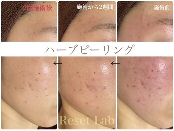 リセットラボ 本店(Reset Lab)/ハーブピーリング before→after