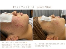 ステラ(STELLA)/フェイシャル　Before After