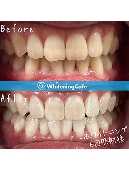 ホワイトニングカフェ 黒崎店(WhiteningCafe)/◎ホワイトニング症例写真◎