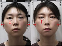 さつま骨格矯正 HRD広尾 西麻布院 /歪み小顔矯正 BeforeAfter