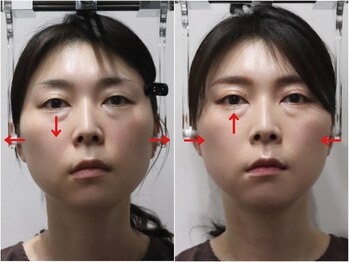 さつま骨格矯正 HRD広尾 西麻布院 /歪み小顔矯正 BeforeAfter