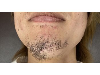 モアナ 前橋店(Moana)/ヒゲ脱毛