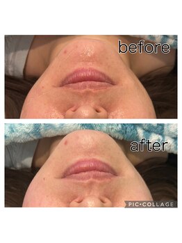 レイモード(Ray mode)/BBLフェイシャル&パック