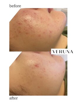 ココ 2号店(CoCo)/肌質改善/ニキビケア