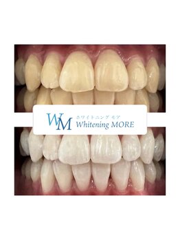 ホワイトニング モア(Whitening MORE)/ビフォーアフター