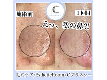 エステティックルーム プラスシー(+C)の雰囲気(毛穴エクストラクションで!黒いぽつぼつ詰まりなどお悩み改善♪)