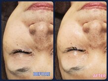 マニル アンド ネトラ(manil & netola)/ハイドロ＋ヒト幹細胞培養液導入