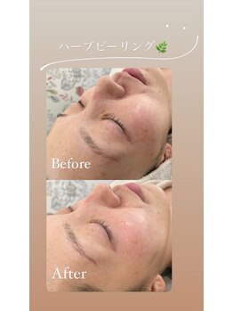 ミント(mint)/#毛穴洗浄 #ハーブピーリング