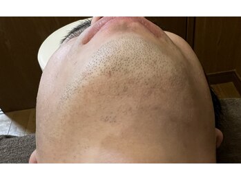 モアナ 前橋店(Moana)/ヒゲ脱毛