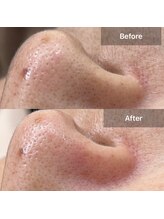 サロン ウイ(salon u'i)/～毛穴エクストラクション～