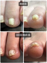 ラリベルテ(La liberte)/～巻き爪・陥入爪補正～