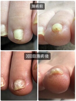 ラリベルテ(La liberte)/～巻き爪・陥入爪補正～