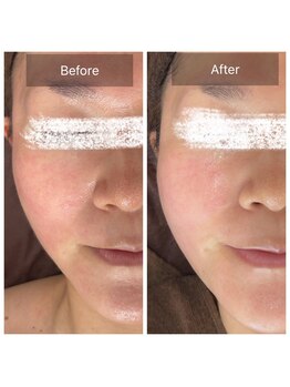 ラビ(RABBI)/40代女性小顔矯正コース