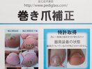 巻き爪補正