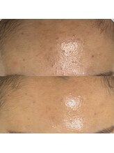 ウララ(ulala)/セラピールビフォアフ