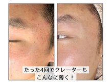 【PLASMAIPS】毛穴レス・ニキビケア・美肌・肌質改善・凹凸改善・目元のたるみ改善