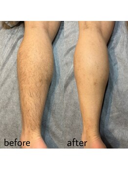 ヴィシアス(VIXIAS)/脱毛 施術1回 １ヶ月後