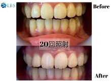 LBSホワイトニング 吉祥寺店の雰囲気（20回照射、5来店で9トーンUP！）