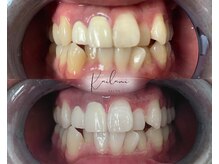 カイラニ サロン(Kai lanl salon)/ホワイトニング