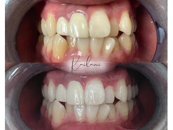 カイラニ サロン(Kai lanl salon)/ホワイトニング