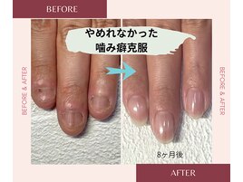 噛む癖！驚異の8ヶ月後