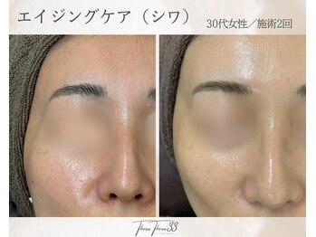スリースリー 恵比寿(THREE THREE)/エイジングケア・しわ・たるみ