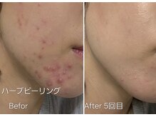 マロン(MARON)の雰囲気（ハーブピーリング/フェイスラインニキビ/肌質改善）
