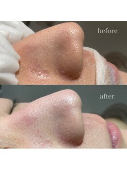 シャルム ド ケー(charme de k)/る最強毛穴洗浄