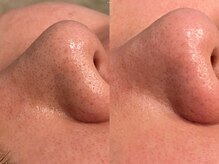 リンク(Re:nk)/ハイドロフェイシャル(毛穴洗浄)