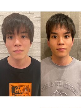 長寿鍼灸院 長寿整骨院/men's美容鍼ハリネズミコース★