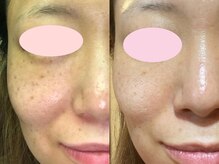 エヴェリーナ(Eveliiina)/44歳★11回シミケア