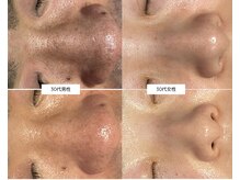 サロンベース(salon BASE)/黒ずみ毛穴の悩みにアプローチ！