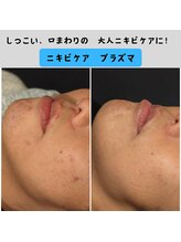 トリニティスペース(TrinitySpace)/ニキビケア・プラズマ